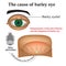 Diseases of the eye barley. Causes of barley