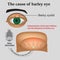 Diseases of the eye barley. Causes of barley