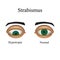 Diseases of the eye - strabismus. A variation of