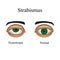 Diseases of the eye - strabismus. A variation of