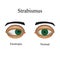 Diseases of the eye - strabismus. A variation of strabismus - Esotropia
