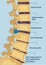 Diseases of the spine. Degenerative changes in the vertebrae