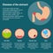 Diseases of the stomach. Vector illustration