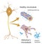 Disintegrating microtubules in Alzheimer disease