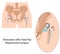 Dislocation after hip replacement surgery