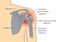 Dislocation Shoulder symptoms or separated.