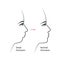 Distal bite profile before and after orthodontic treatment. Human with malocclusion, lower jaw pushing back, bite