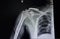 distal clavicle fracture and pulmonary tuberculosis