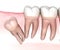 Distal impaction of Wisdom tooth. Medically accurate tooth 3D illustration