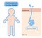 Distribution of Eccrine sweat glands in human body and skin diagram. Health care concept