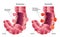 Diverticulosis & Diverticulitis