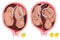 Dizygotic and monozygotic twins