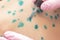 Doctor applies Viride nitens to the body of a child with chickenpox. Varicella. Infectious viral