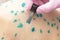 Doctor applies Viride nitens to the body of a child with chickenpox. Varicella. Infectious viral