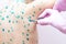 Doctor applies Viride nitens to the body of a child with chickenpox. Varicella. Infectious viral skin