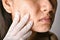 Doctor or Dermatologist hand exam patient face. Skin problems and acne scar, Acne facial care treatment