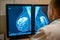 Doctor examines mammogram snapshot of breast of female patient on the monitors. Selective focus.