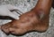 Doctor examining swollen foot or pitting oedema in foot of patient with chronic renal failure or kidney injury.