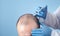 Doctor makes injection in the man head for hair growth