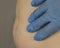 A doctor probes a woman`s belly with stretch marks, close-ups stomach