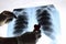 Doctor`s hands hold a toy heart near an X-ray of the lungs, chest of a patient with pneumonia virus. Copying space is the concept