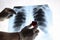 Doctor`s hands hold a toy heart near an X-ray of the lungs, chest of a patient with pneumonia virus. Copying space is the concept