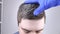 Doctor trichologist in blue medical gloves examines the gray hair of a young man. The concept of early graying of hair in young pe