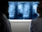 Doctors diagnosing lung cancer from x-ray