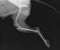 Dog Leg X Ray Showing Intramedullary Pin Fixation of a Proximal Tibial Fracture