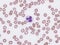 Dohle bodies in a neutrophil.