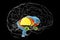 Dorsal striatum and lateral ventricles in the brain of a person with Huntington's disease