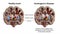 Dorsal striatum and lateral ventricles in healthy brain and in Huntington's disease