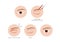 Double eyelid surgery infographic step vector / cosmetic surgery