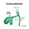 Double gall bladder. Pathology of the gallbladder. Cholecystitis.