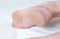 Dry cracked skin on the heels of a person s legs, close-up. The concept of serious diseases of the skin and thyroid gland,