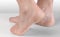 Dry and cracked soles of feet on gray background, foot with dry heels, cracked skin heel of foot with bad skin is covered with