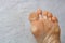 Dry skin, plantar callosity and flakes on the female feet sole