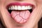 Dry Tongue Pain And Cracks