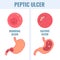 Duodenal and gastric types of peptic ulcer stomach disease