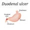 Duodenum ulcer affected. Duodenal ulcer. Vector illustration on a background of isolation