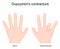 Dupuytren`s contracture. Comparison and difference of a healthy hand and Dupuytren`s disease in left hand