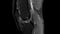 Dynamic scrolling through MRI images of knee joint. Diagnosis sport trauma and damage of ligaments. Magnetic resonance