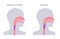 Dysphagia medical poster