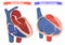 Ebstein anomaly versus normal heart structure vector illustration