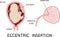 Eccentric insertion of umbilical cord. insertion site varies from the center of the fetal surface to the border of the placenta