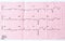 ECG with acute period of large-focal widespread anterior myocardial infarction