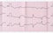 ECG with acute period macrofocal myocardial infarction and vent