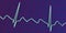 ECG in atrial flutter, 3D illustration