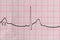 ECG Electrocardiography