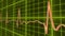 ECG line graph, heart beating in normal sinus rhythm, healthcare and medicine